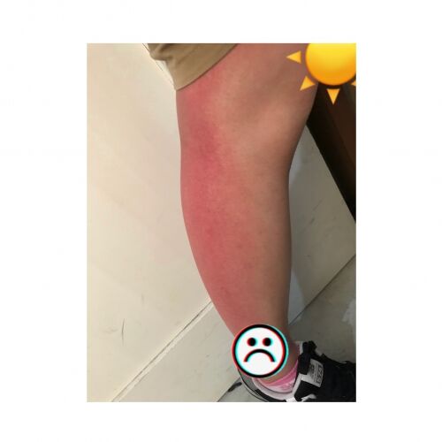 夏も本番??UV対策失敗。笑